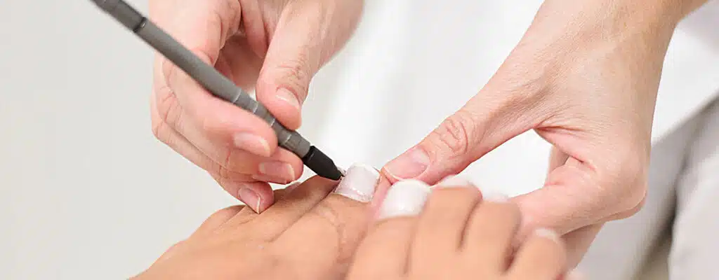 Pinpointe Nagellaser Behandlung