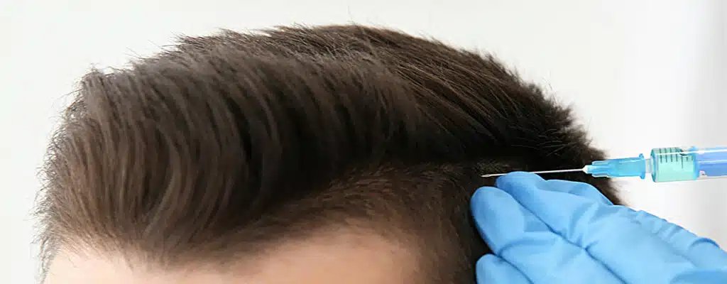 Behandlung der Kopfhaut bei der Haartransplantation